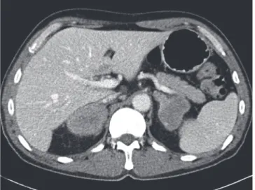 Fig. 2.  Abdomen CT scan at diagnosis showed about 6.4 cm sized adrenal  gland masses