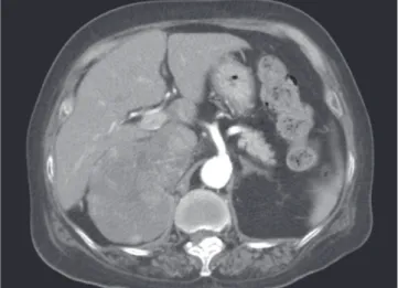 Fig. 2.  PET-CT shows highly  active lesion in right adrenal  area.