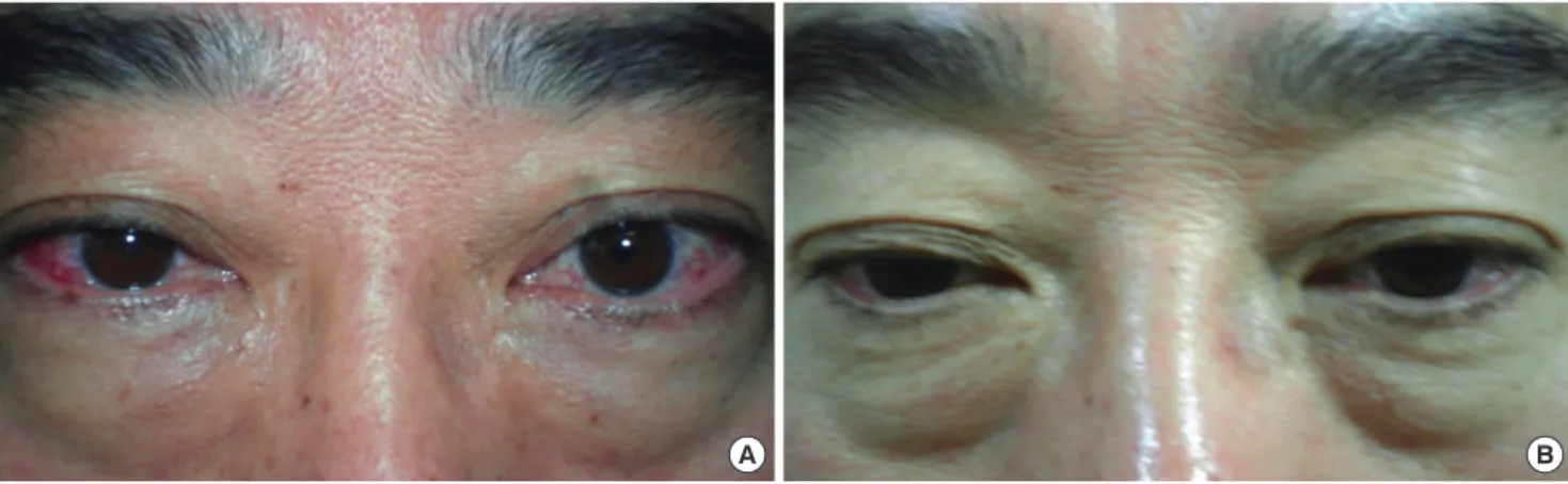 Fig. 1. Ocular manifestations of the patient. A. Before embolization treatment, the patient presented bilateral proptosis, periorbital edema, conjunctival injection  and chemosis