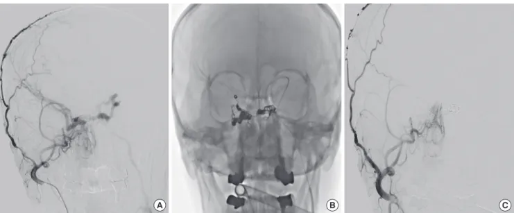 Fig. 2. Before embolization treatment. Orbital computed tomography revealed dilated left superior ophthalmic vein (white arrow, A) and dilated left cavernous sinus  (Black arrow, B).