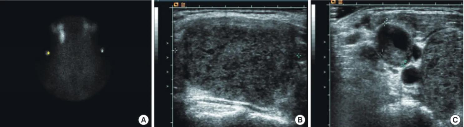 Fig. 1.  Thyroid scan and ultrasonography findings. A. 99mTc thyroid scan showed markedly decreased uptake in thyroid area