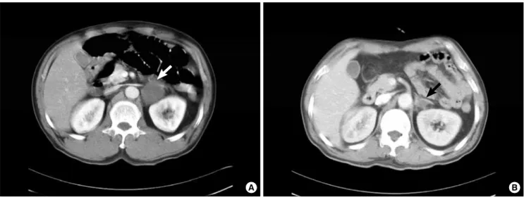 Fig. 1.  A. Abdominal computed tomography shows about 4 × 4 cm sized, relatively well-defined low density mass lesion with peripheral wall enhancement (arrow)  in the left adrenal gland