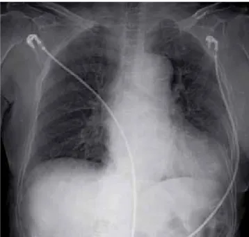 Fig. 1.  Initial ECG at emergency room showed T wave inversion in precordial 
