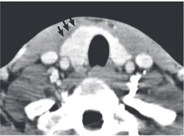 Fig. 2.  Computed tomography scan showed 2.2 cm sized hypodense enhanc- enhanc-ing mass (arrows) in right lobe.