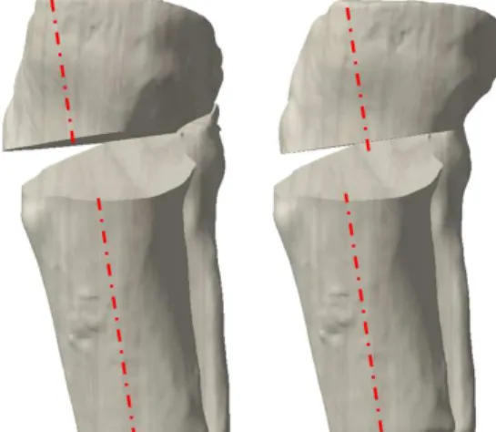 Fig.  3  Different  tibial  positions  with  the  same  coronal    angle and posterior slope angle (Sagittal plane) 