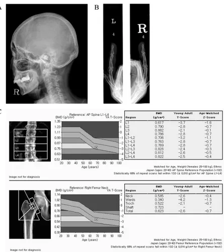 Fig.  1.  Radiologic  findings  of  hyperparathyroidism.  A.  Skull  X-ray  shows  heterogeneous  salt  and  pepper  appearance  of  skull