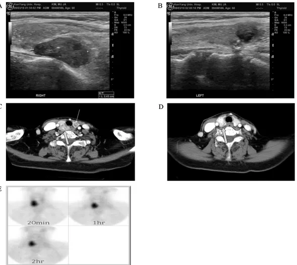 Fig.  2.  A,  B.  A  preoperative  neck  ultrasonography.  Ultrasonographic  findings  of  the  neck  shows  about  2.43  cm  sized  mass  lesion  is  seen  in  right  lower  perithyroid  area  (A),  about  1  cm  sized  cystic  lesion  is  seen  in  left