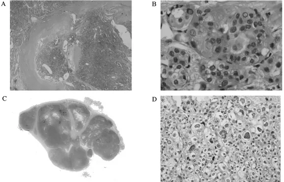 Fig.  3.  A,  B.  Microscopic  examination  of  the  right  lobe  of  the  thyroid  gland  after  decalcification  shows  a  nodular  tumor  with  ossification  in  a  low-power  view  (A,  ×12.5)  and  many  nuclear  pseudoinclusions  in  a  high-power  v