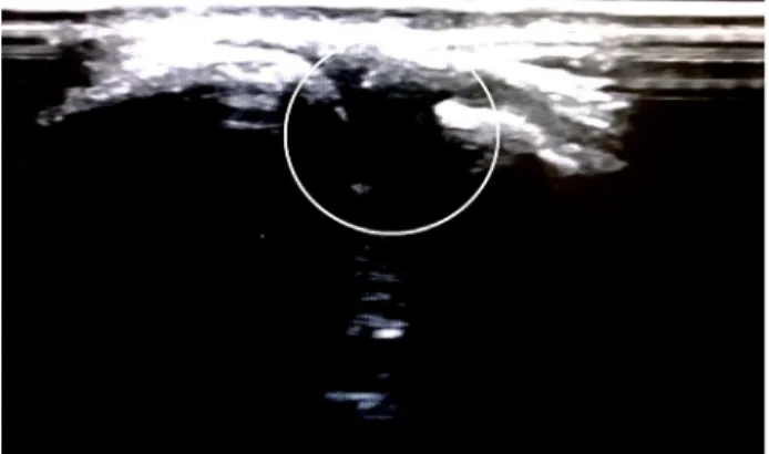 Fig.  1. Sonography  of  acromioclavicular  joint.