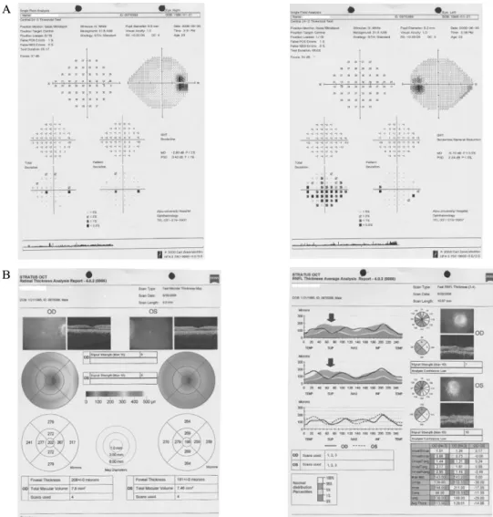 Fig.  2.  Ophthalmologic  examination.  A.  Visual  field  analysis  showed  generalized  reduction  of  sensitivity  without  significant  visual  field  defect  in  both  eyes