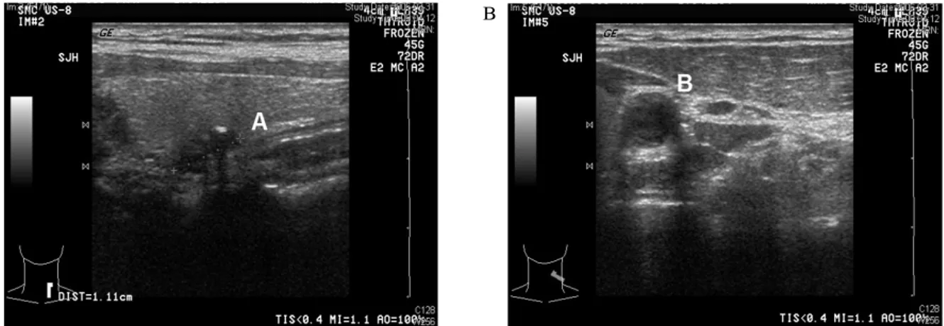 Fig.  1.  Thyroid  ultrasonography.  Ultrasonographic  evaluation  shows  0.8  ×  0.5  cm  indeterminate  nodule  (A)  and  small  cyst  adjacent  to  the  nodule  (B)  in  posterior  aspect  of  left  thyroid  gland.