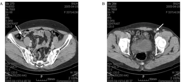 Fig.  2.  Computed  tomography  scan  of  the  abdomen  (case  4).  A.  Bilateral  intra-abdominal  testes  are  atrophied  (arrow)