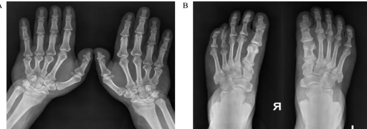 Fig.  2.  Plain  radiograph  of  hand  with  shortened  of  Rt.  third,  fourth  metacarpals  and  second,  third  and  fourth  metacarpals  (A),  foot  with  shortened  of  Rt