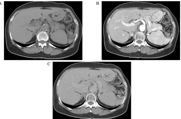 Fig.  1.  Pre-enhanced  (A),  early-enhanced  (B)  and  delayed-enhanced  (C)  computed  tomographic  images  of  the  abdomen