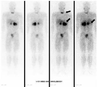 Fig.  3.  F-18  FDG  PET  CT.  focal  hypermetabolic  lesion  in  the  left  thyroid  gland  (arrowhead),  mild  hypermetabolic  lesion  in  the  right  thyroid  gland  suggesting  a  malignancy  and  heterogeneous  hypermetabolic  masses  in  both  adrena