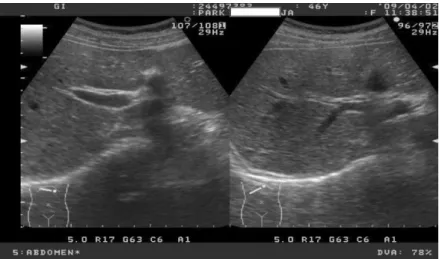 Fig.  2.  Ultrasonography  of  patient's  liver.  Increased  echogenecity  was  indicative  of  diffuse  liver  parenchymal  disease.