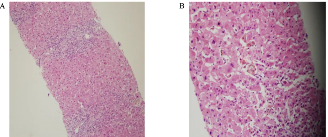 Fig.  3.  Pathologic  findings  of  liver  biopsy.  A.  Marked  infiltrations  of  portal  and  periportal  lymphocytes  and  macrophages  were  noted,  which  is  a  typical  finding  of  chronic  hepatic  inflammation  (×100)