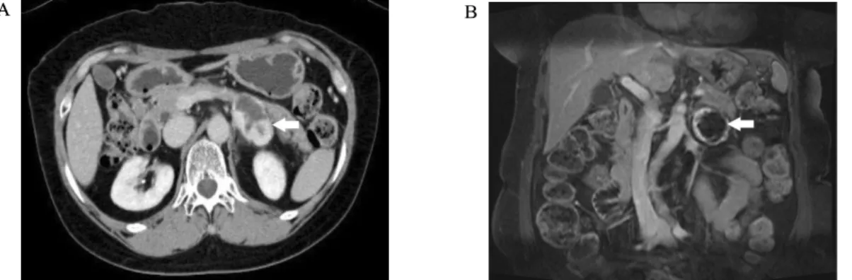 Fig.  2.  EUS  showed  that  a  well-circumscribed  heterogeneous  hypoechoic  mass  with  internal  cystic  change  (A)  originated  from  the  lateral  rim  of  the  left  adrenal  gland  (B,  arrow).