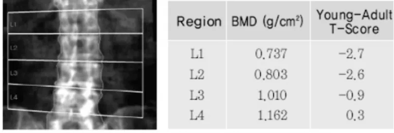 Fig.  7.  Measurement  of  bone  mineral  density  using  DXA.