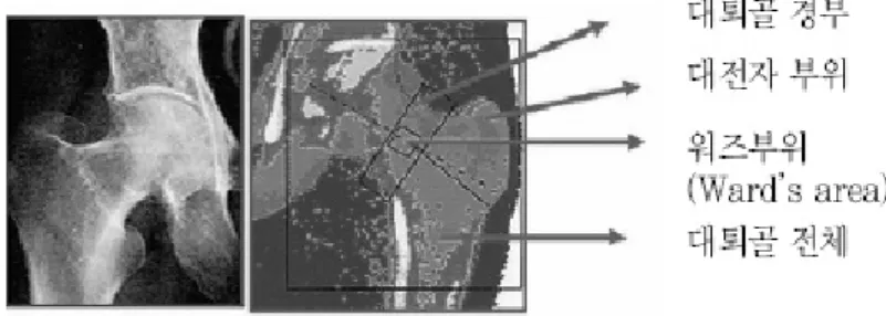 Fig.  8.  ROI  of  hip  BMD.