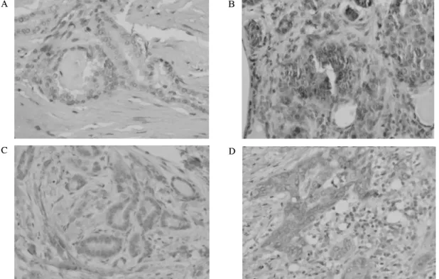 Fig.  1.  S100A4  and  COX2  immunostaining  in  papillary  thyroid  carcinoma.  It  is  noted  few  positive  cells  in  well  defined  mass  (a,  S100A4,  X200)  (c,  COX2,  X200)