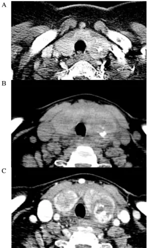 Fig.  1.  CT  of  chest  and  neck.  A.  Chest  CT  revealed  calcified  nodule  in  left  lower  lobe  of  thyroid