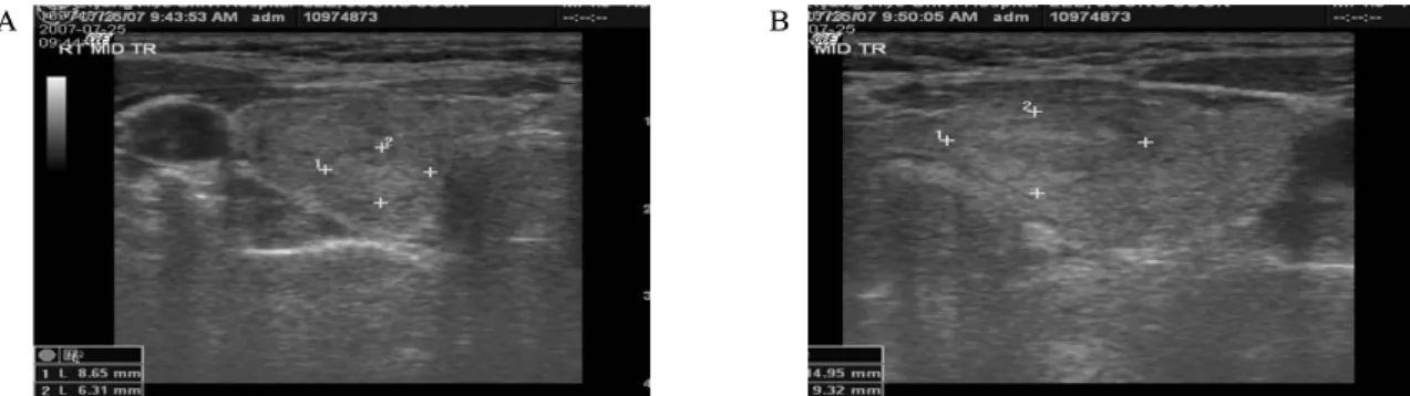 Fig.  2.  Specimen  form  fine  needle  aspiration  show  atypical  spindle  cells  having  elongate  nuclei  and  pseudoinclusions.