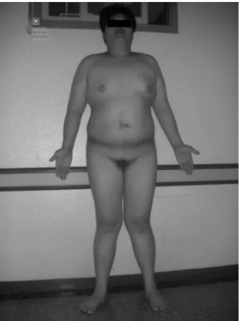 Fig.  1.  Clinical  feature  of  the  patient.  He  showed  obese  build  and  gynecomastia,  axillary  hair  loss,  genu  valgum  and  he  had  a  small  penis  and  scrotums