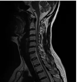Fig. 3. C-Spine MRI (18. 3. 15).2) 주소증(1) 경부 신전 시 후경부,  양측 수지,  허리 하부,  양측 다리까지 찌릿하게 전기가 통하는 느낌 호소(2) 후경부, 양측 승모근에 지속적으로 저림 증세 호소(3) 양측 수지부 지속적 탈력감 및 둔한 감각 호소(4) 양측 소퇴 후면으로 저림이 심하고 보행 시 바로 양측 하지부위 전체적으로 탈력감 호소3) 발병일2017년 10월경 일상생활 중 증상 發4) 치료기간 2018 년 3월 말
