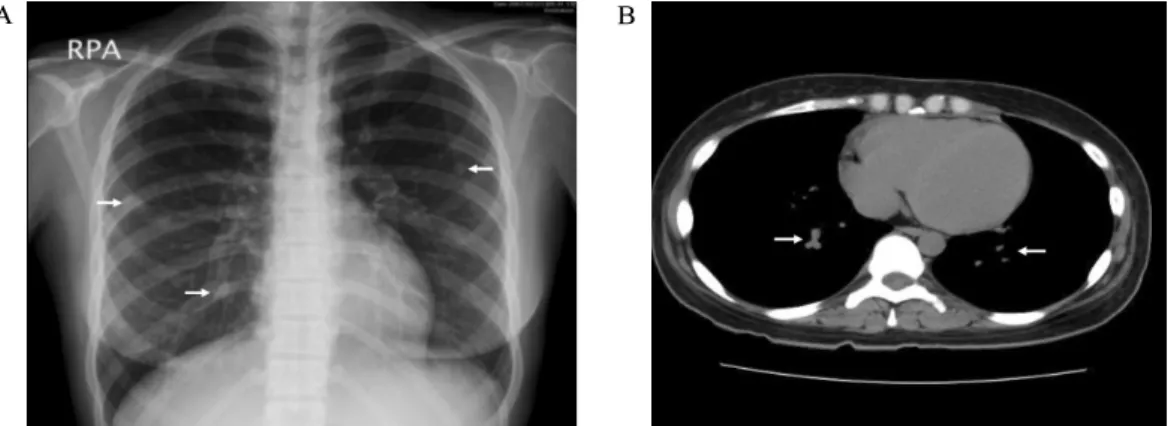 Fig.  1.  Neck  CT  shows  multiple  enlarged  lymph  nodes  in  bilateral  submandibular  spaces  and  bilateral  internal  jugular  chain  (arrows).