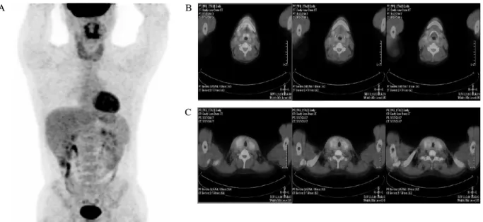 Fig.  3.  PET-CT  scan  shows  diffuse  increased  FDG  uptake  in  thyroid  gland  (A),  multiple  nodal  activities  in  the  right  internal  jugular  chain  (B,  C),  and  no  other  abnormal  FDG  uptake  in  the  body  (A).