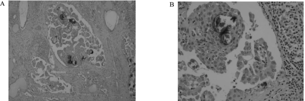 Fig.  4.  Microscopic  finding:  Tumor  has  multiple  nodular  structures  in  the  entire  thyroidal  parenchyma  and  shows  lymphocytic  infiltration  and  fibrosis  (A)