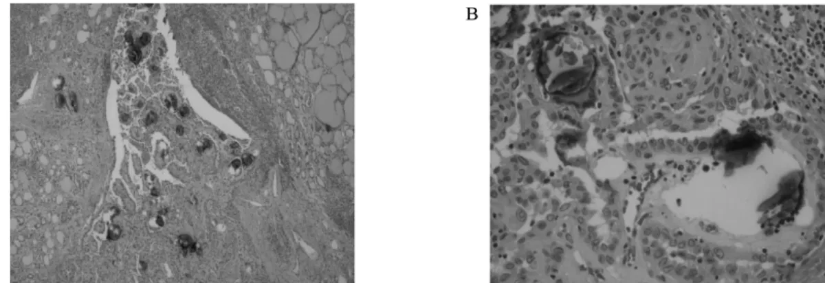 Fig.  8.  Microscopic  finding:  Thyroid  gland  shows  multiple  variable-sized  nodular  structures  with  numerous  psammoma  bodies,  lymphocytic  infiltration  and  fibrosis  in  entire  thyroid  parenchyma  (A)