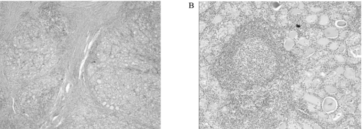 Fig.  5.  Histology  confirms  the  diagnosis  of  Hashimoto's  thyroiditis.  A.  The  glandular  architecture  is  destructed  with  dense  lymphocytic  infiltration  and  thick  fibrous  bundles  (H&amp;E  stain,  ×100)