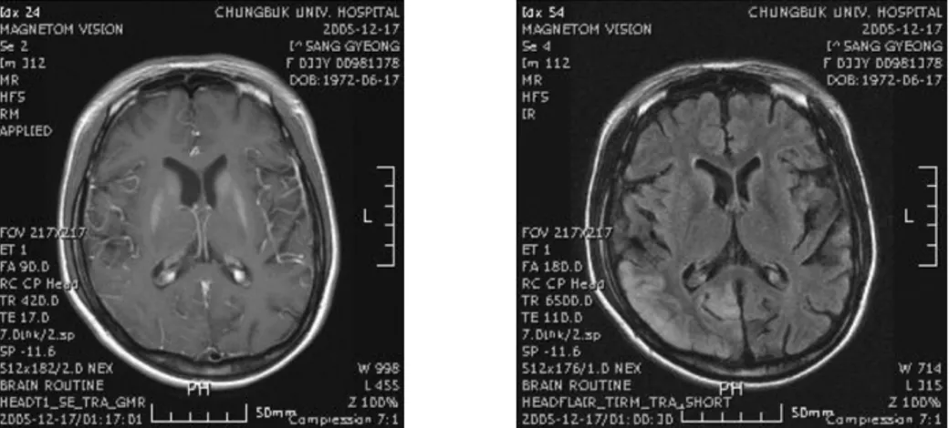 Fig.  1.  Brain  MRI  shows  diffuse  cerebral  atrophy  and  non-enhancing  high  signal  intensity  in  both  caudate  nucleus,  putamen,  globus  pallidus  and  hypothalamus.
