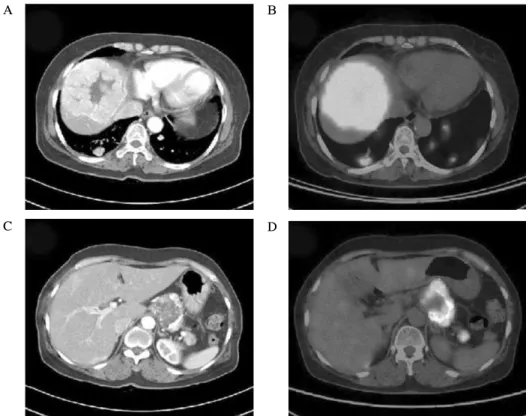 Fig.  1.  Liver  dynamic  CT  shows  large  hypervascular  mass  (diameter;  9.5  cm)  in  anterior  segment  of  right  liver