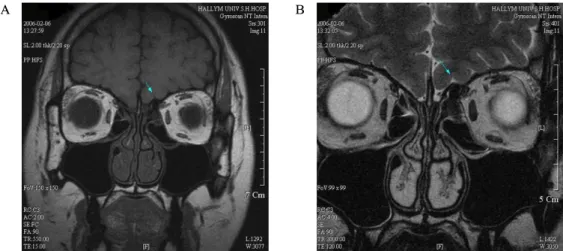 Fig  1.  Olfactory  MRI  -  Coronal  Section  (A-T1,  B-T2  image).