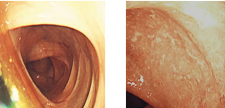 Fig.  2.  Colonoscopic  findings.  Diffuse  inflammation  and  ulceration  was  observed  at  rectum  from  anus  to  upper  part  above  20  cm
