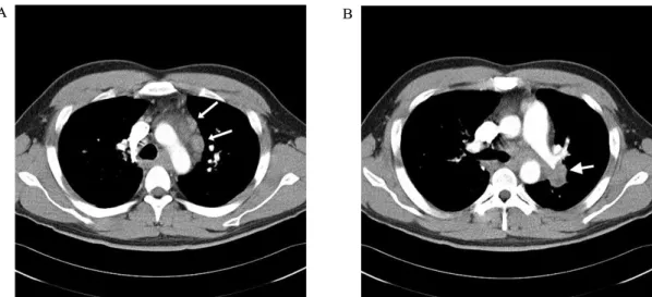 Fig.  1.  Chest  x-ray  shows  ovoid  opacity  at  left  suprahilar  portion  (white  arrow)