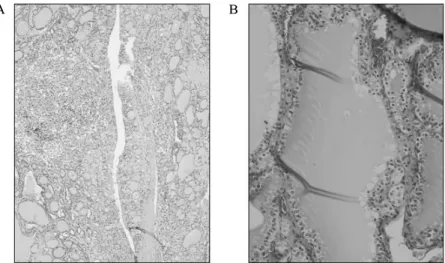 Fig.  2.  Histology  of  thyroid.  A,  There  is  nodular  Hashimoto’s  thyroiditis  (H&amp;E, 