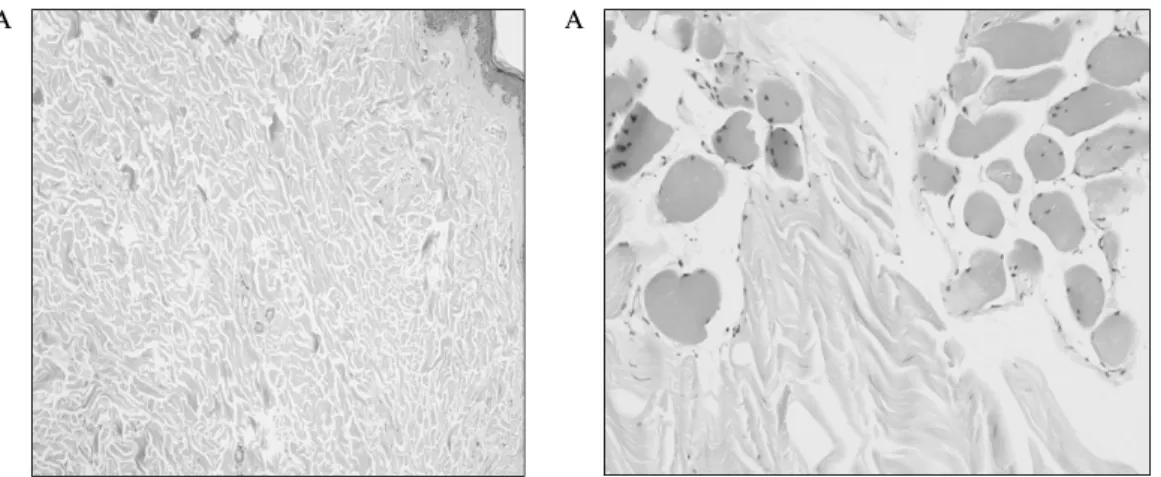 Fig.  3.  Histology  of  skin  biopsy.  A,  There  are  hyalinized  collagen  bundles  with  atrophic  adnexa  and  perivascular  lymphoid  infiltration  (H&amp;E,  ×40);  B,  There  is  hyalinized  intermysial  fibrous  tissue  (H&amp;E, 