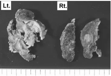 Fig.  4.  Pathologic  finding  of  left  thyroid  nodule  showed  typical  pattern  of  papillary  carcinoma  with  characteristic  nucleic  features  (A:  H&amp;E,  ×100  B:  H&amp;E,  ×200)