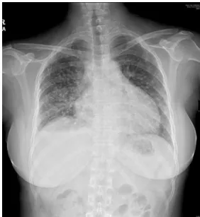 Fig.  1.  Chest  PA  shows  diffuse  micronodular  opacity  at  both  lungs.