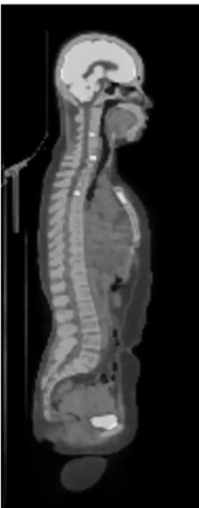 Fig.  4B.  PET  shows  increased  FDG  uptake  in  C4,  C6,  C7,  T1-T4  spines  and  sternum.