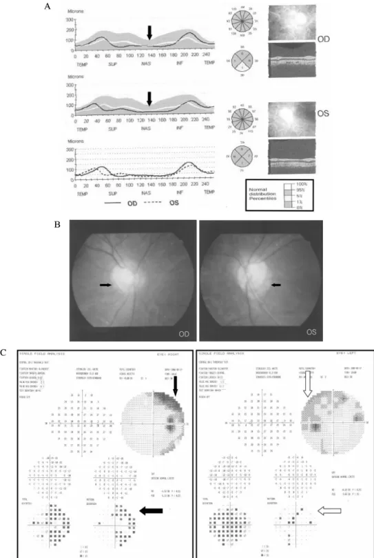 Fig.  2.  Ophthalmologic  examinations  of  the  patient.  (A)  Optical  coherence  tomography  showed  partial  optic  nerve  atrophy