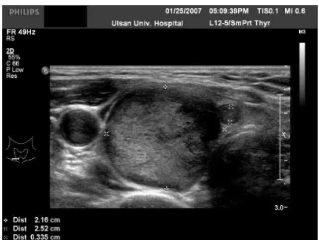 Fig.  1.  Ultrasonographic  finding  of  the  neck  shows  a  2  ×  2  ×  2.5  cm  sized  round  mass  density  under  the  right  lobe  of  the  thyroid  grand.