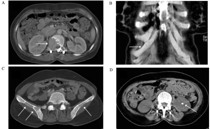 Fig.  4.  Abdominal  CT  scan  shows  multiple  osteolytic  lesions  on  the  1st  lumbar  vertebra  (A),  right  7th  rib  (B)  and  pelvic  bone  (C)