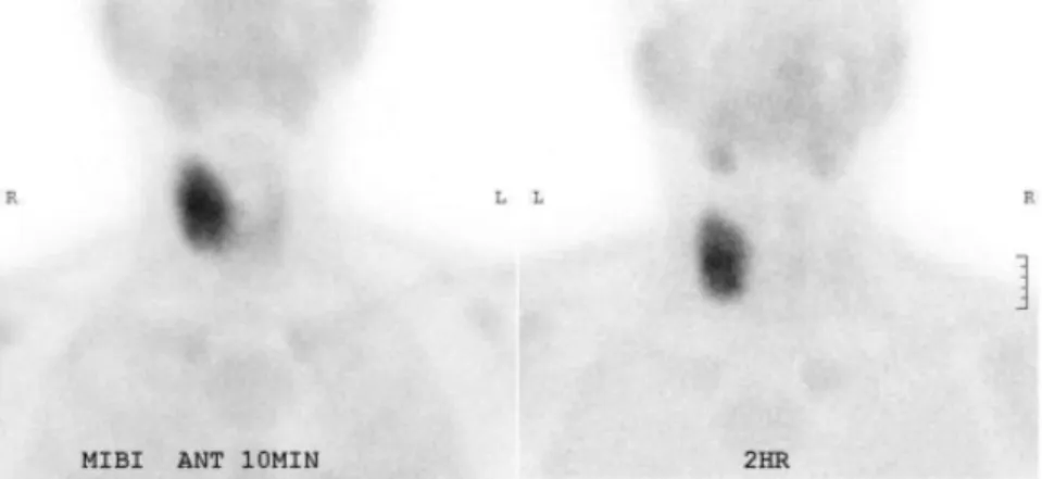 Fig.  1.  Tc 99m -sestamibi  scan  shows  increased  uptake  in  the  right  parathyroid  region.