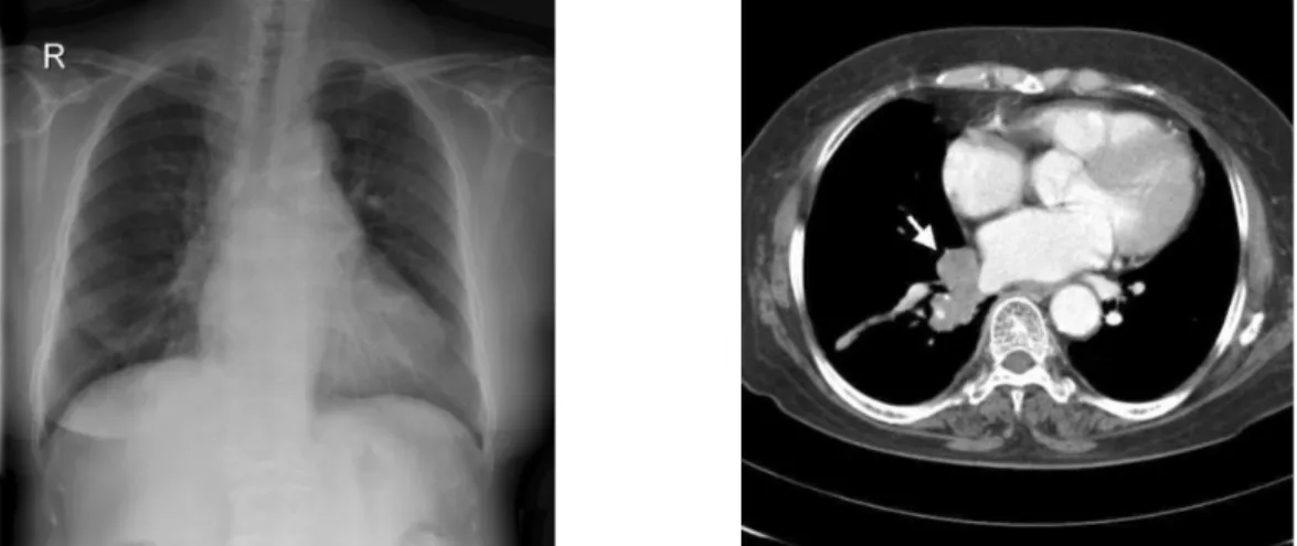 Fig.  3.  Chest  PA  shows  no  definite  abnormalities,  but  chest  CT  scan  shows  3  cm  sized  mass  (arrow)  in  the  right  lower  lobe.