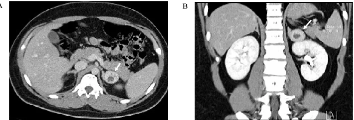 Fig.  4.  Image  of  adrenal  computed  tomography.  The  transverse  view  (A)  and  coronal  view  (B)  of  contrast  material  enhanced  CT  scan  demonstrate  a  2.7  ×  3.5  cm  sized  left  adrenal  incidentaloma,  which  is  well  defined  ovoid  en